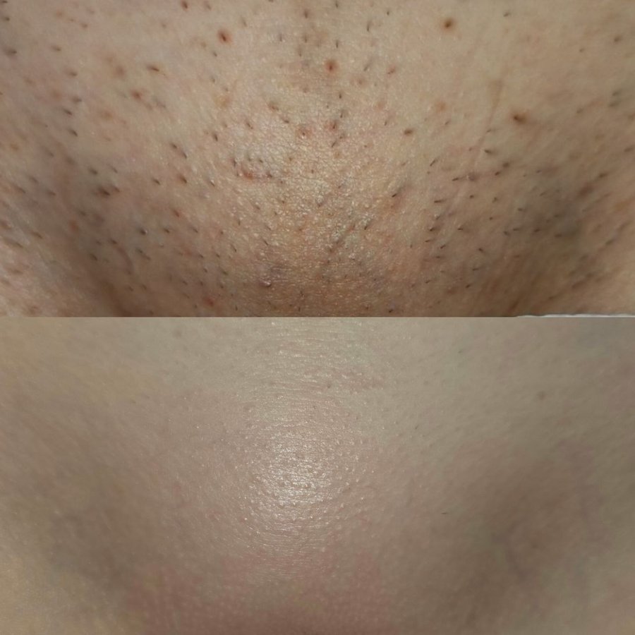 Chin and neck before and after laser hair removal