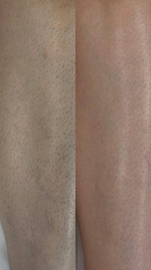 Legs before and after laser hair removal