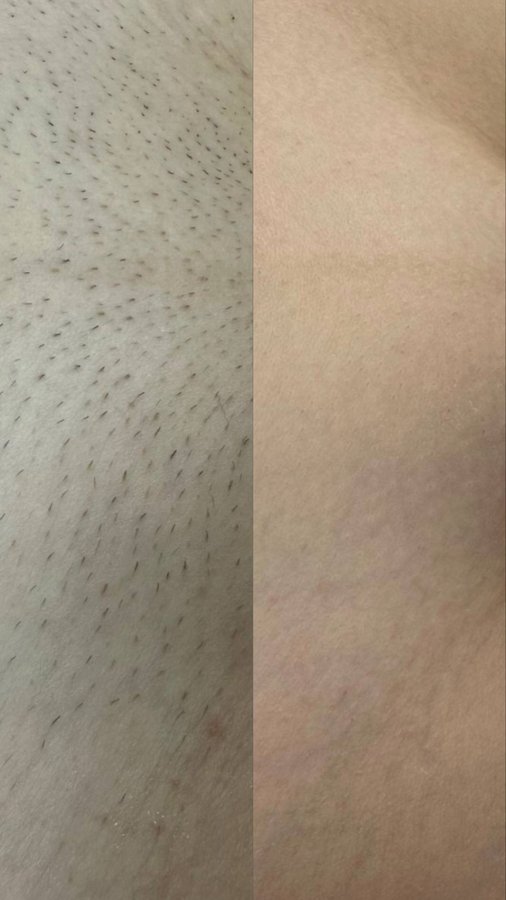 Underarm before and after laser hair removal