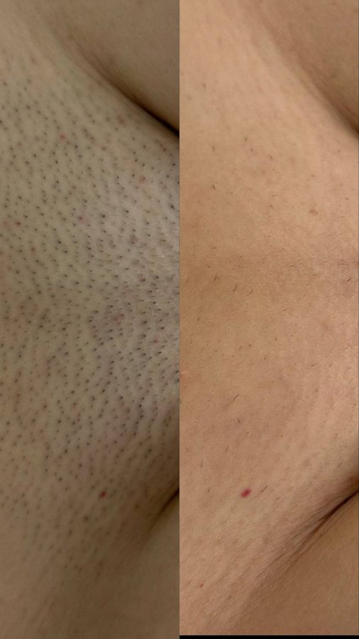 Underarm before and after laser hair removal, second example