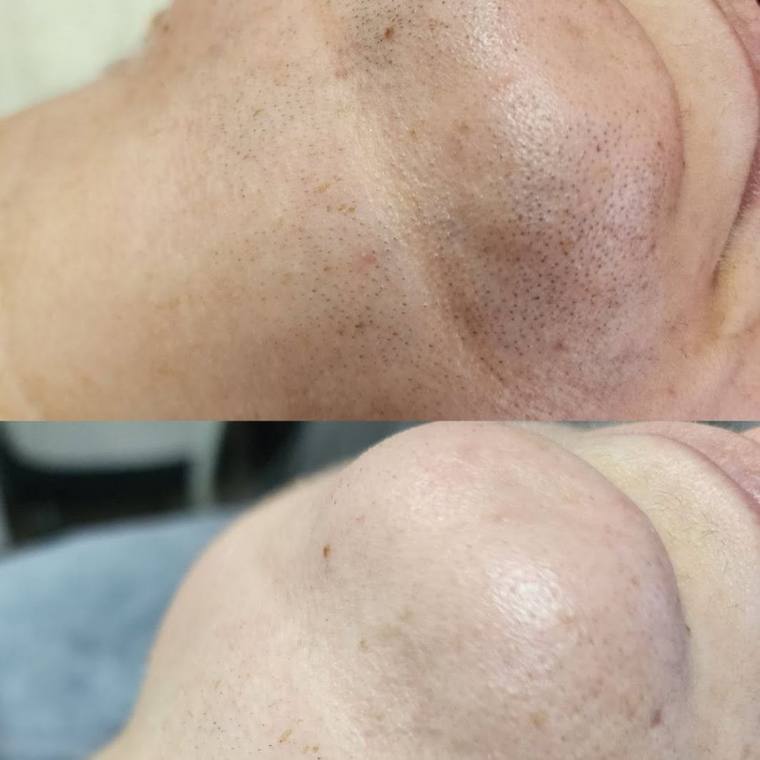Face and neck before and after laser hair removal