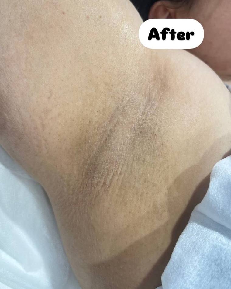 Underarm after laser hair removal, Chorley client