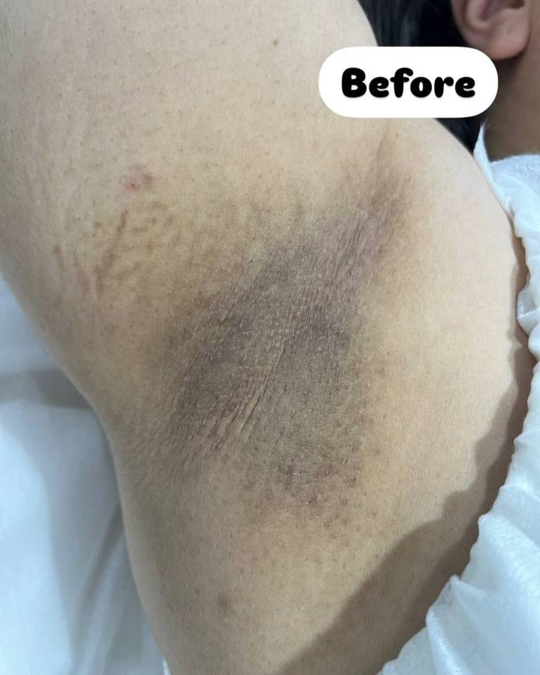 Underarm before laser hair removal, Chorley client